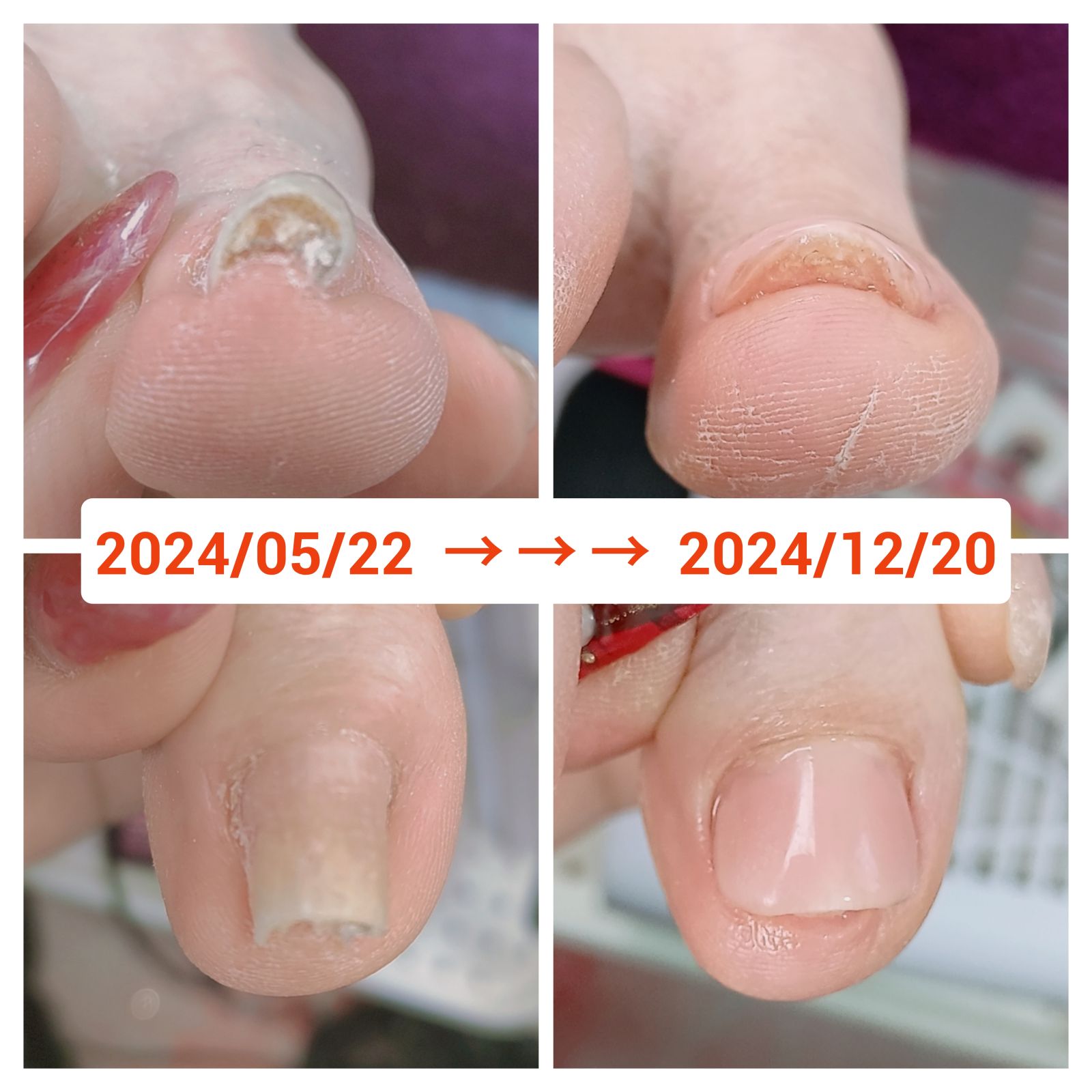 ヘイスイッチ
痛くない巻き爪ケア
親指1本 / 5500円(税込)
親指以外の4本指 / 3300円(税込)