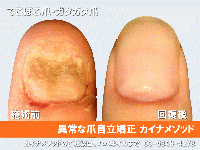 施術内容　爪の異常の改善例-1