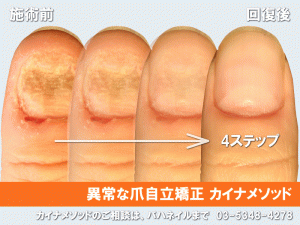 爪の異常自立矯正のカウンセリング
