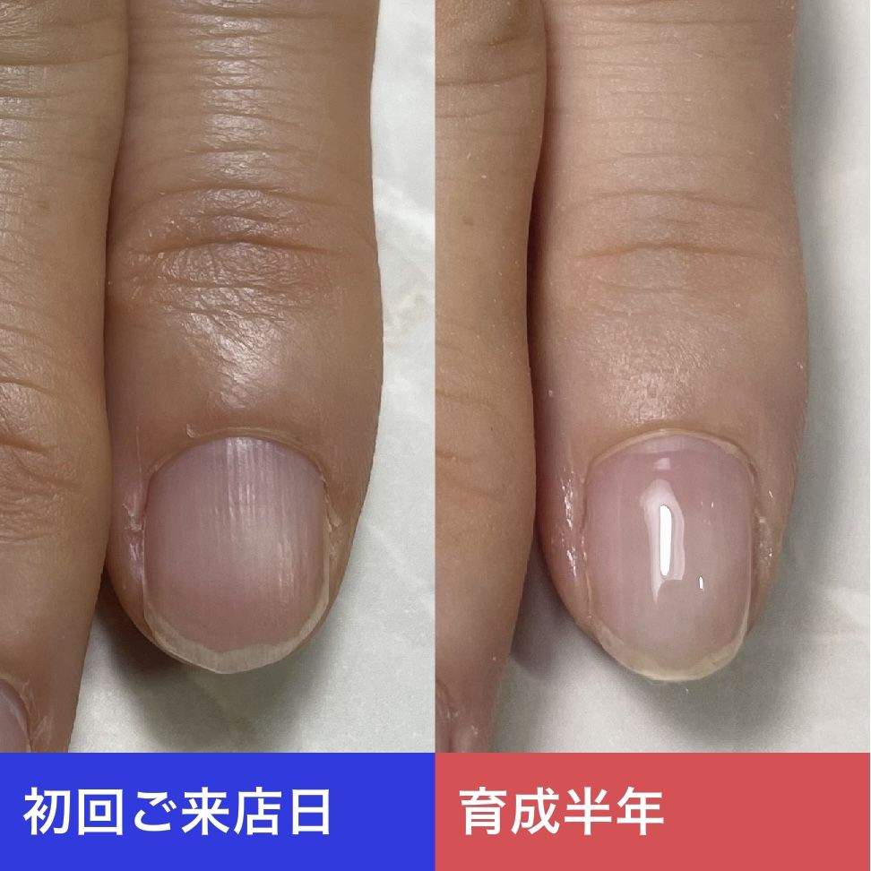 自爪育成半年の経過