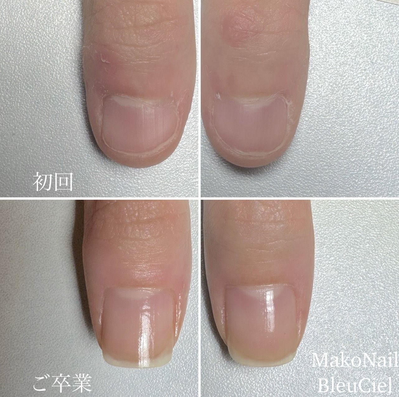 深爪のお客様