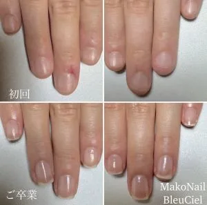 深爪のお客様 - 爪の育成専門　MakoNailBleuCiel