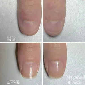 深爪のお客様 - 爪の育成専門　MakoNailBleuCiel