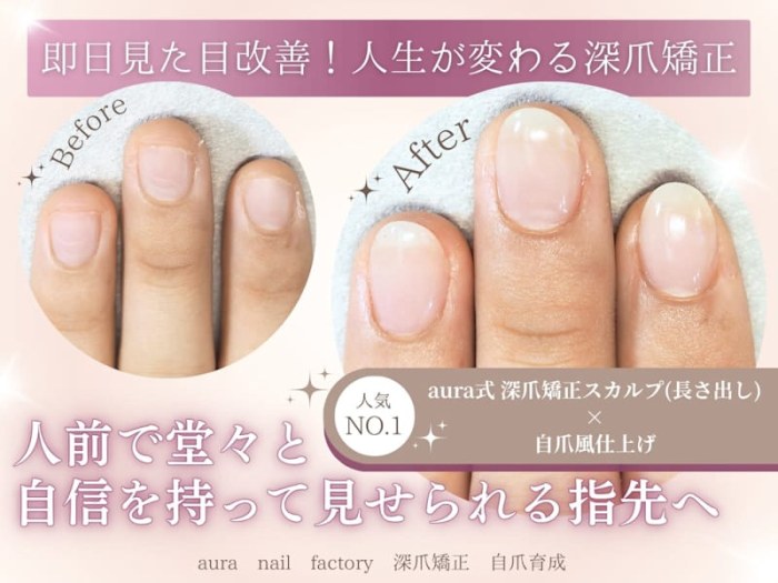 aura 深爪矯正 自爪育成 パラジェル登録サロン