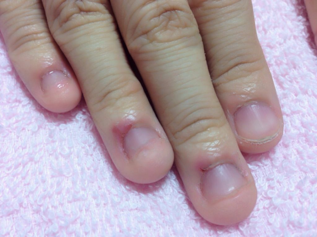 深爪矯正～宝塚ネイルサロンC'z nail