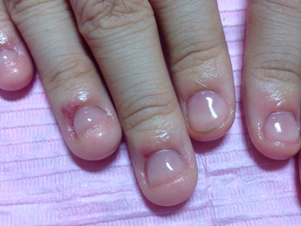 深爪矯正～宝塚ネイルサロンC'z nail