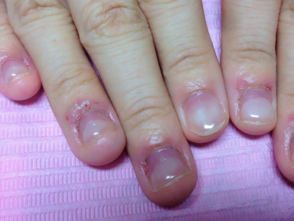 深爪矯正～宝塚ネイルサロンC'z nail