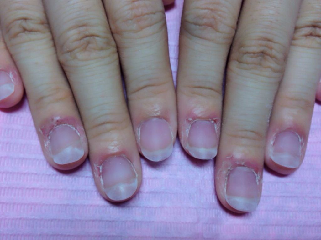 深爪矯正～宝塚ネイルサロンC'z nail