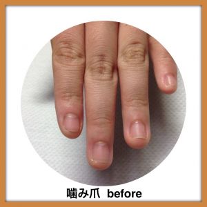 深爪　ビフォー