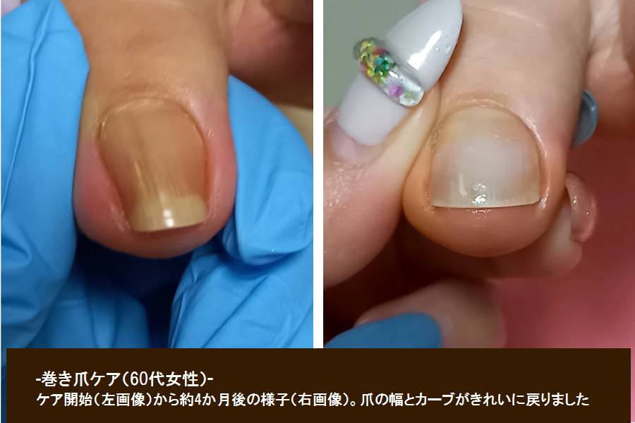 巻き爪やトラブル爪のケアも取り扱っております。お悩みの方はお気軽にご相談下さい。
